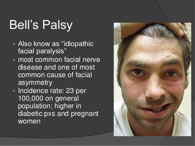 Facial paralysis and neuralgia photo 484